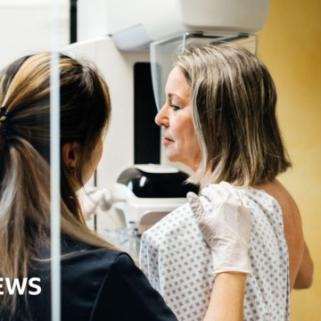 Millions of breast cancer patients could safely avoid chemotherapy, study suggests – BBC