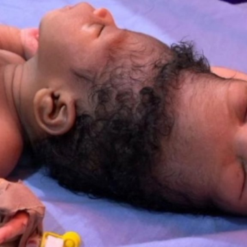 Conjoined twins separated with help of AI – BBC